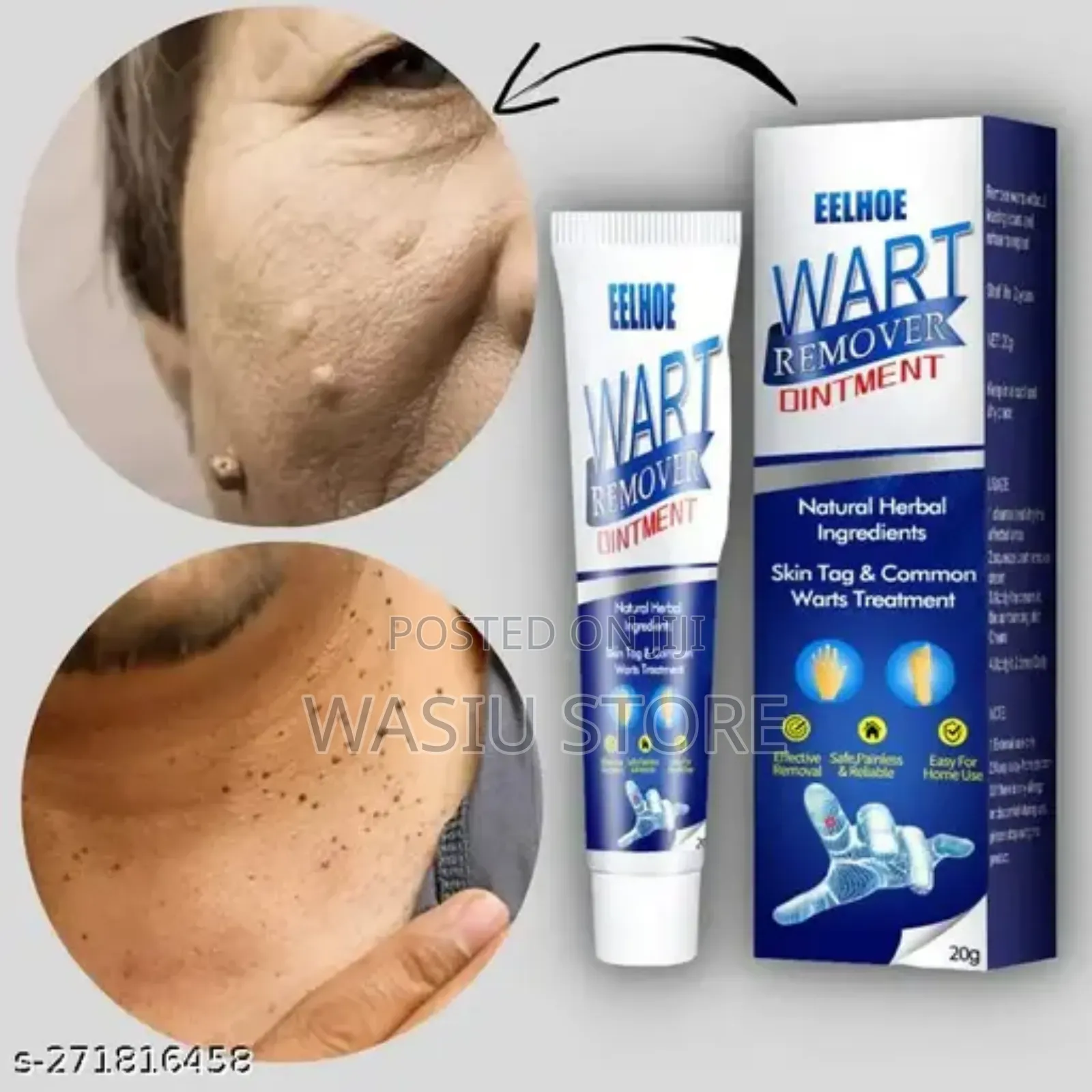 Effective Wart Remover Cream Ointment